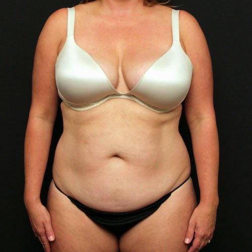 Tummy Tuck with Liposuction Case 25229