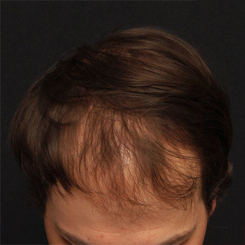Hair Restoration Case 26670