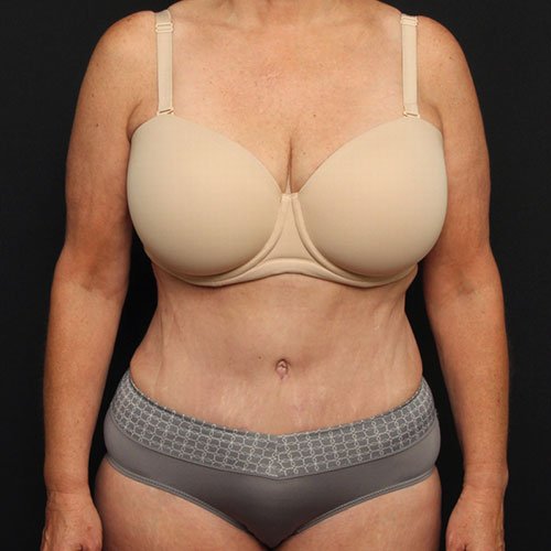 Tummy Tuck with Liposuction Case 26233