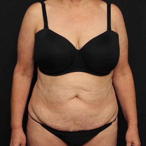 Tummy Tuck with Liposuction Case 26233