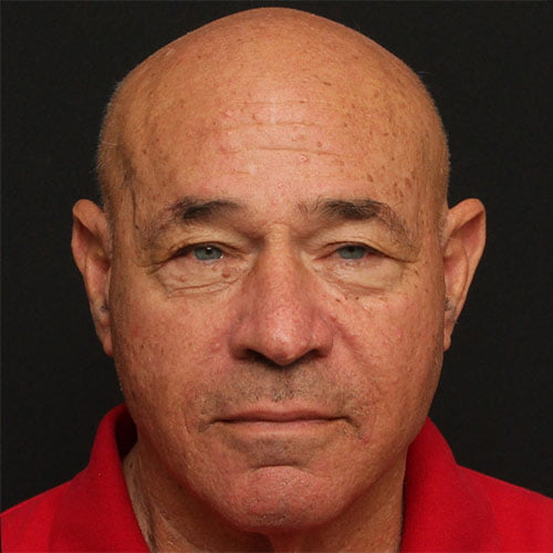 Eyelid Surgery Case 27477