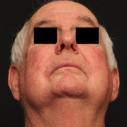 Nasal Rhinophyma Case 27561