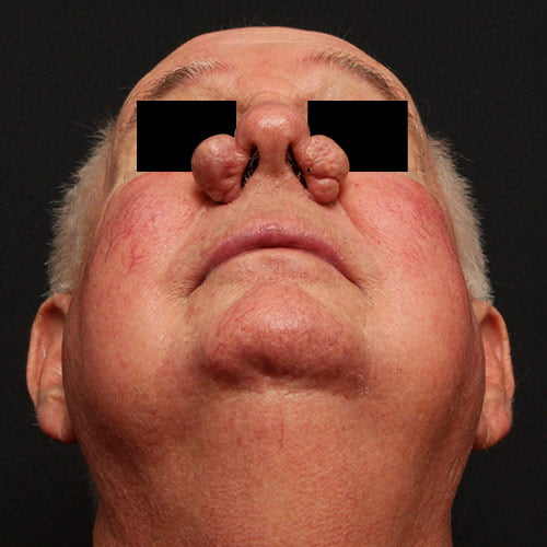 Nasal Rhinophyma