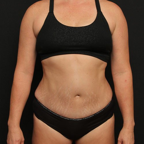 Tummy Tuck with Liposuction Case 27480