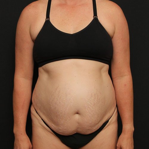 Tummy Tuck with Liposuction Case 27480