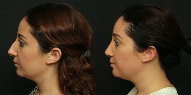 Female patient of Dr. Duplechain shown before and after rhinoplasty surgery