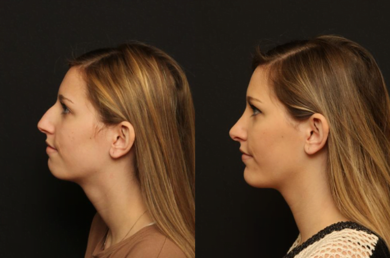 Female patient of Dr. Duplechain shown before and after rhinoplasty