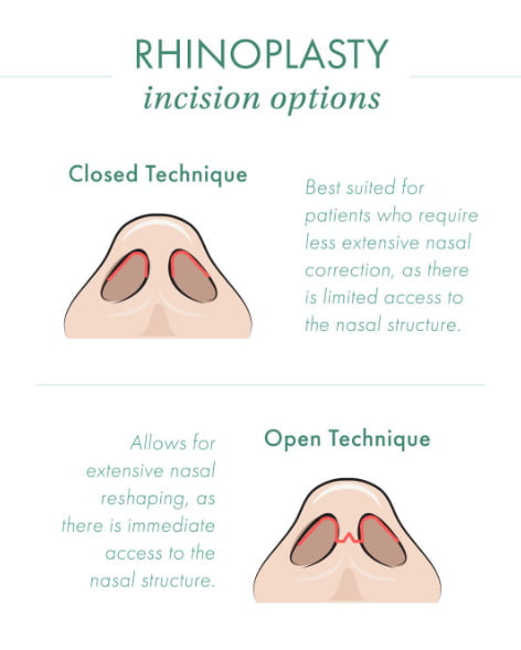 Rhinoplasty incision options: Open vs Closed 