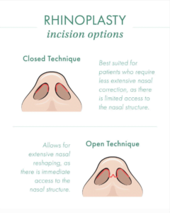 Rhinoplasty Incision Options: Open vs. Closed - Dr. Duplechain ...