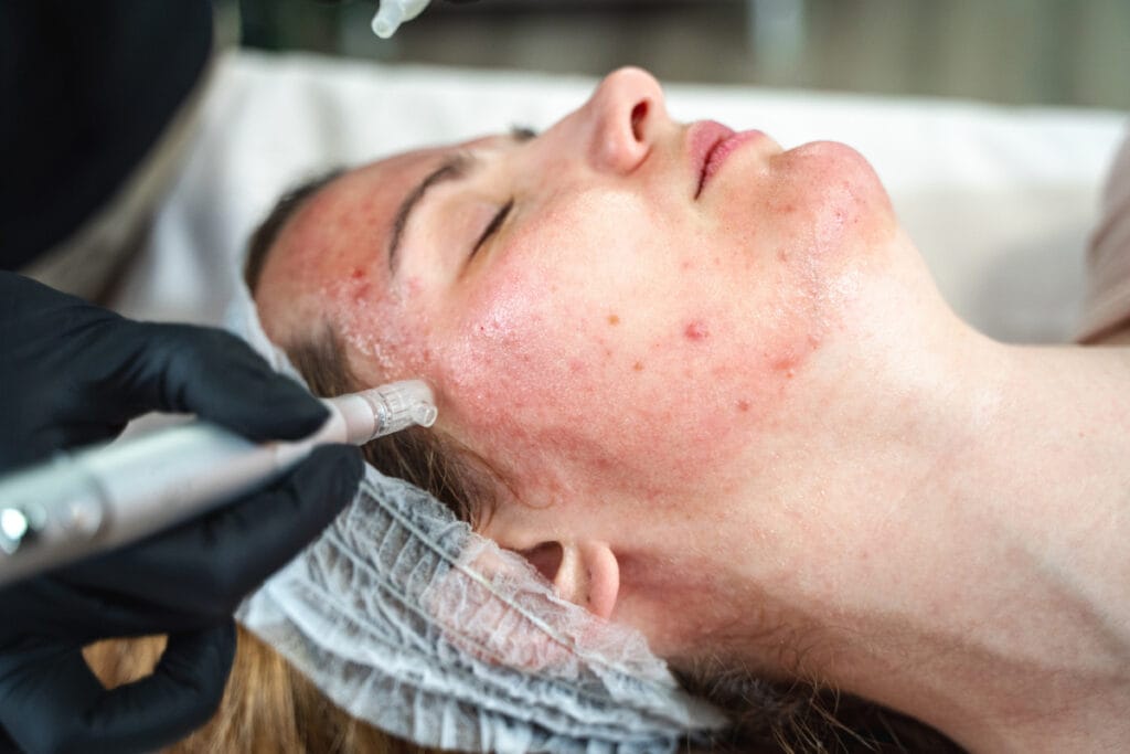Woman getting microneedling skin treatment at a med spa