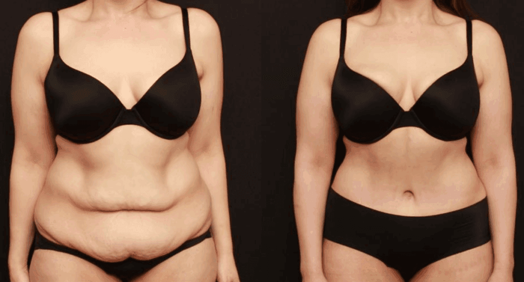 Full tummy tuck with liposuction results