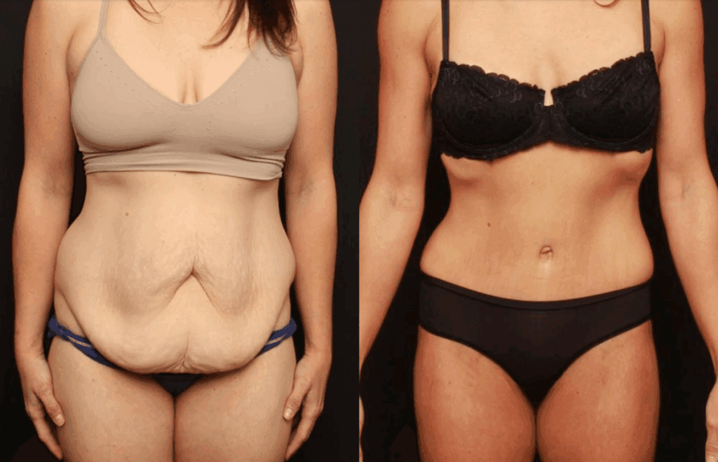 Extended tummy tuck in Lafayette with Dr. J. Kevin Duplechain