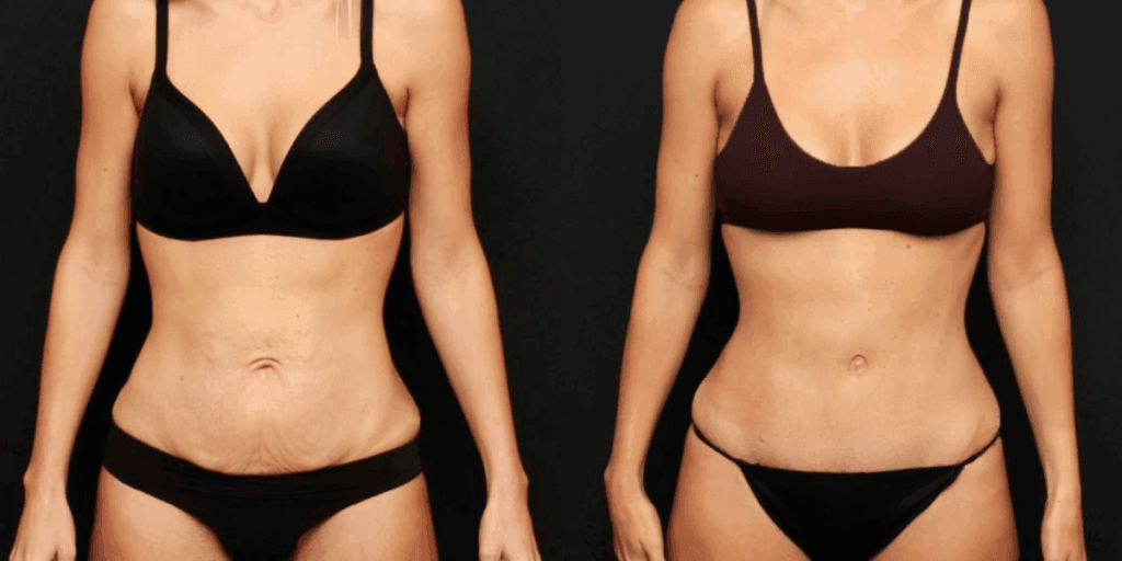 Before and after tummy tuck with liposuction in Lafayette, Louisiana with Dr. Duplechain