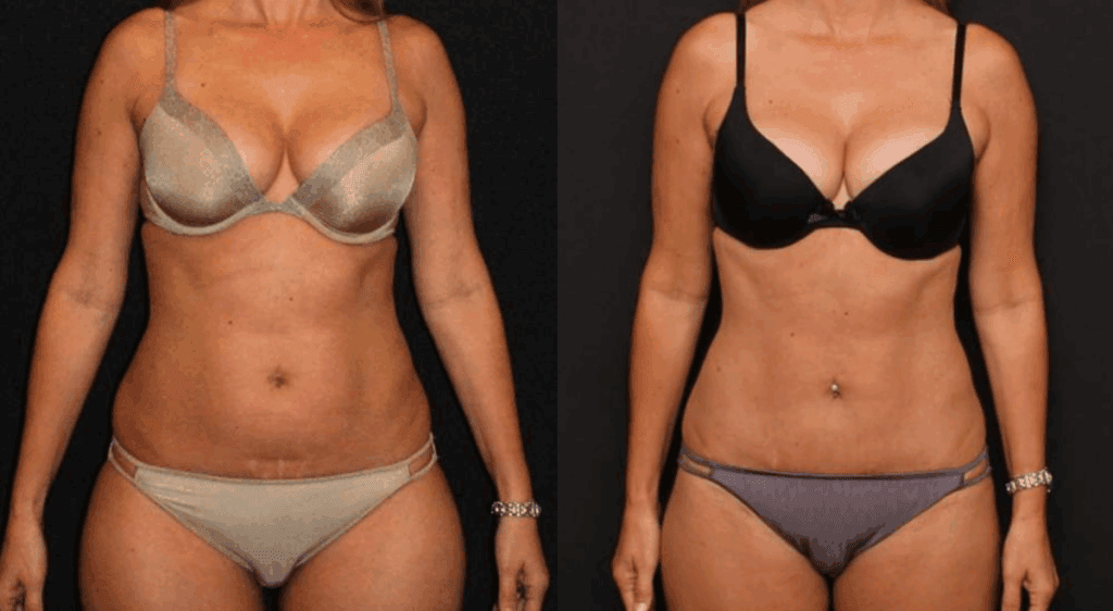 Before and after Lafayette Liposuction and Tummy Tuck with Dr. Duplechain