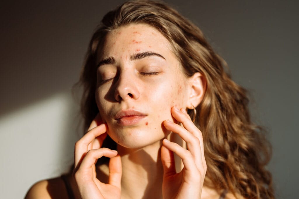 Young woman with acne