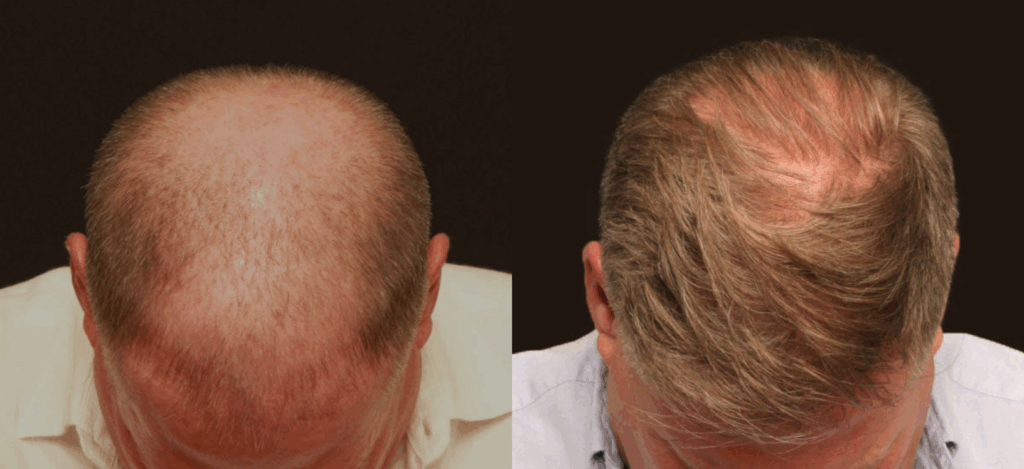 Before and after hair restoration with Dr. Duplechain in Lafayette, LA