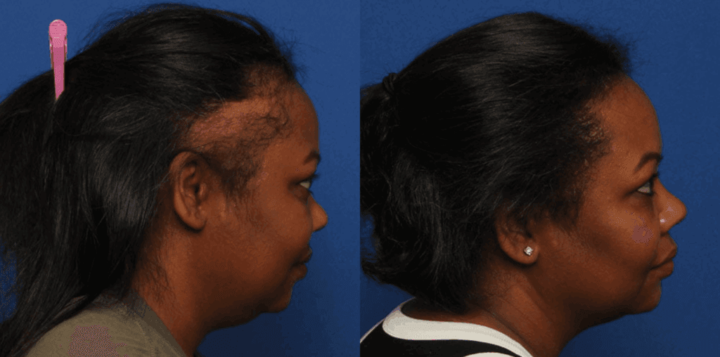 Before and after NeoGraft hair transplant Lafayette, LA