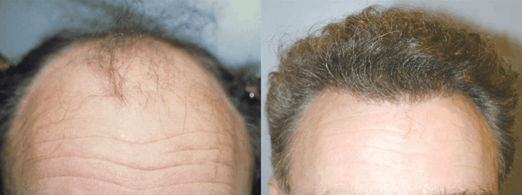 Before and after NeoGraft hair transplant in Lafayette, LA