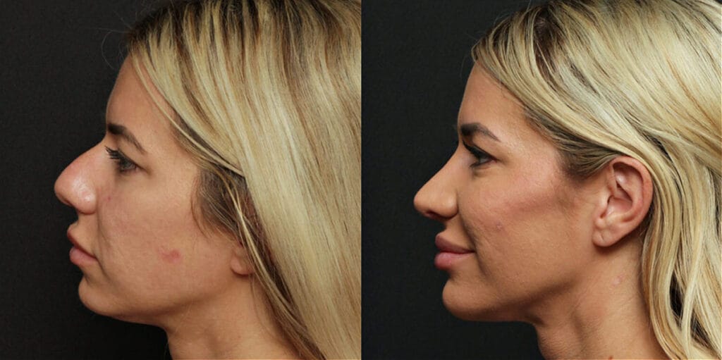 Before and after rhinoplasty in Lafayette, LA with Dr. Kevin Duplechain