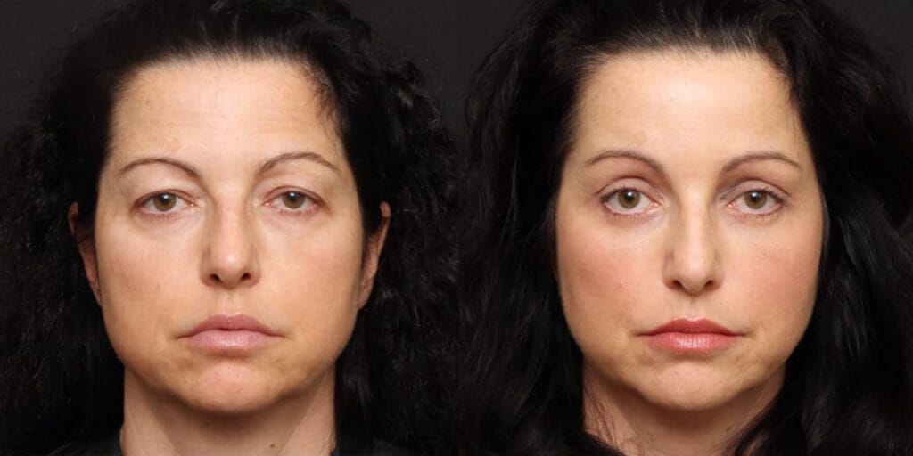 Female patient before and after upper and lower blepharoplasty and a brow lift with Dr. Duplechain in Lafayette, LA