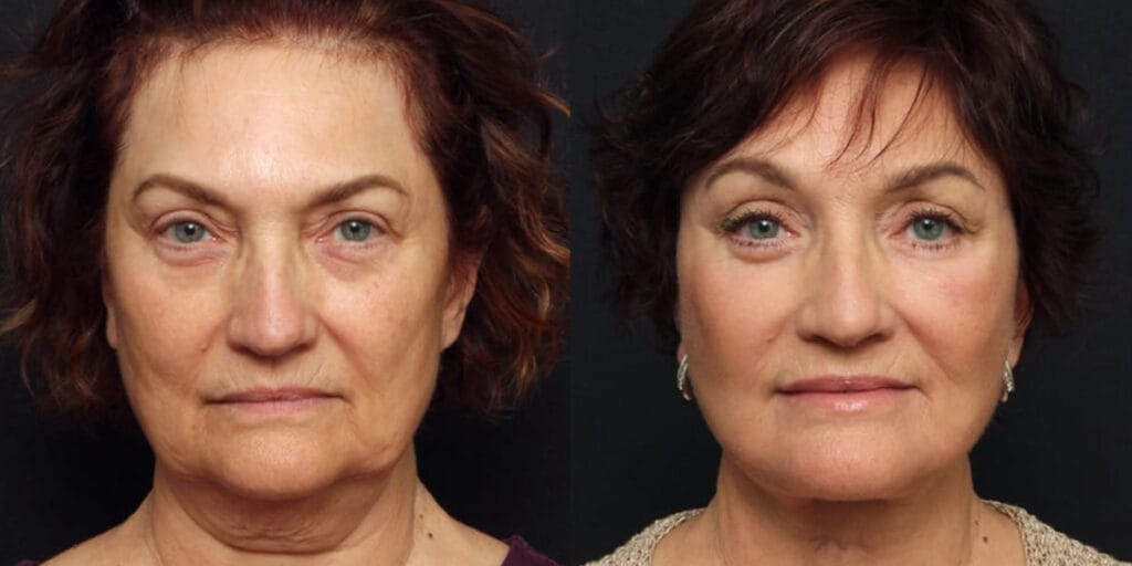Before and after facelift, brow lift, upper and lower blepharoplasty, full face CO2 laser and fat transfer to face with Dr. Duplechain in Lafayette, LA