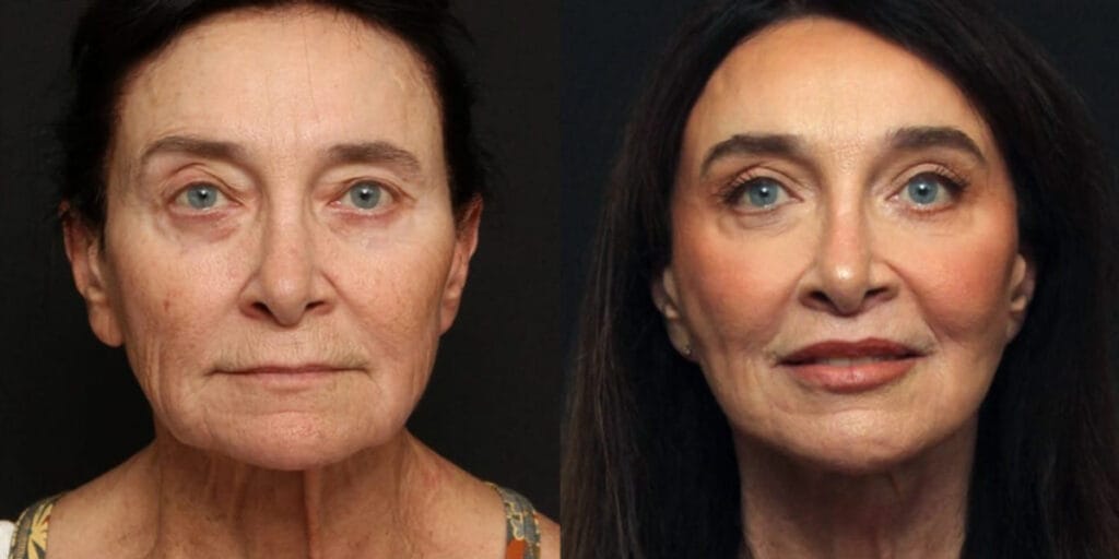 Before and after facelift, brow lift, upper and lower blepharoplasty, bullhorn lip lift, fat transfer to face, and full face CO2 laser with Dr. Duplechain in Lafayette, LA