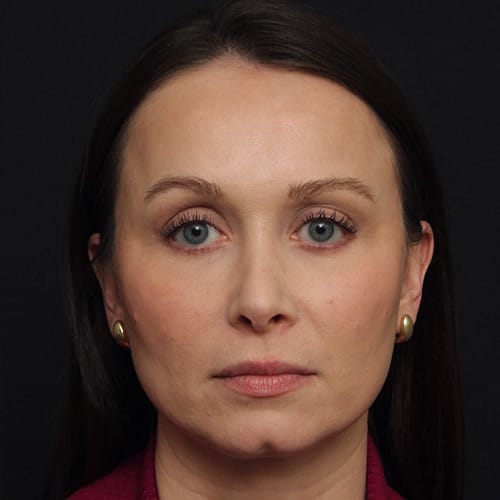 Eyelid Lift & CO2 Laser Case 50002