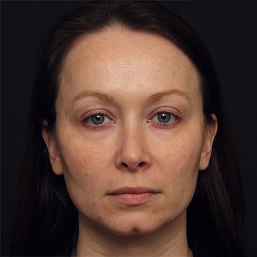 Eyelid Lift & CO2 Laser Case 50002