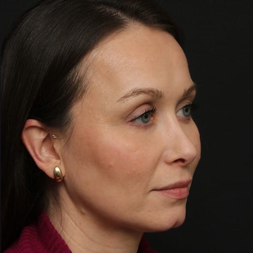 eyelids-CO2-laser-50002b-after-duplechain