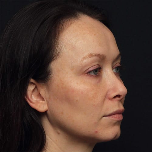 eyelids-CO2-laser-50002b-before-duplechain