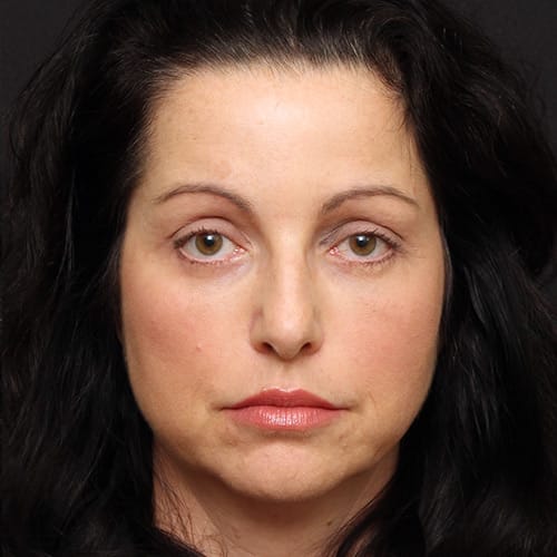 Eyelid Lift & Browlift Case 50001