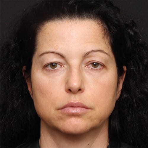 Eyelid Lift & Browlift Case 50001