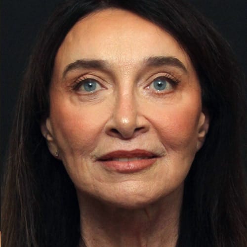 Facial Rejuvenation Case 50004