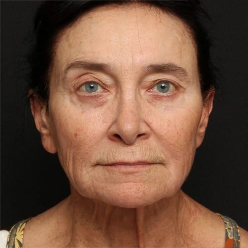 Facial Rejuvenation Case 50004
