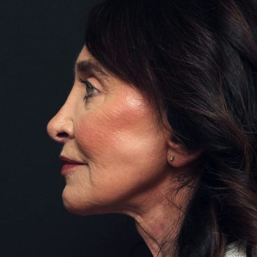 face-multi-procedure-50004c-after-duplechain