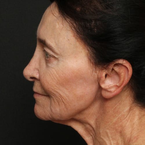 face-multi-procedure-50004c-before-duplechain