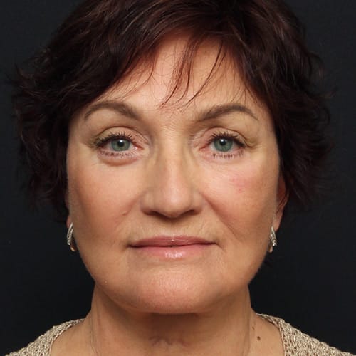 Facial Rejuvenation Case 50003