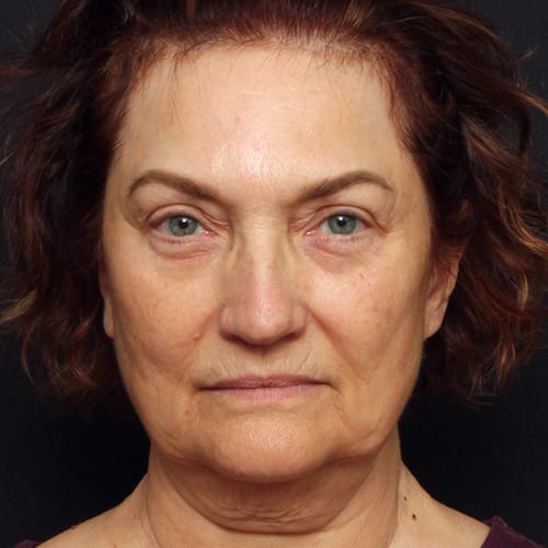 Facial Rejuvenation Case 50003