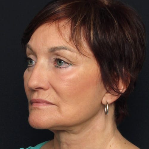 face-multi-procedures-50003b-after-duplechain